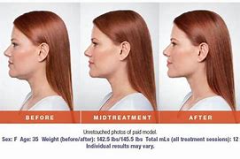 Image result for Kybella vs CoolSculpting Chin
