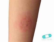 Image result for Fungal Infection On Arm
