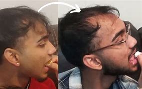 Image result for Balding in Teens