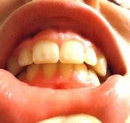 Image result for Can Invisalign Fix Overbite
