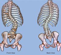 Image result for Scoliosis Ribs