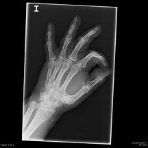 Image result for calcificar