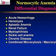 Image result for Normocytic Anemia