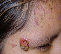 Image result for Epidermodysplasia Verruciformis