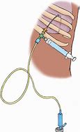 Image result for Needle Thoracentesis