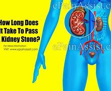 Image result for What Does a 4 mm Kidney Stone Look Like