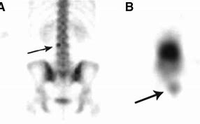 Image result for Abnormal Bone Scan