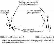 Image result for Bundle Branch Block Treatment