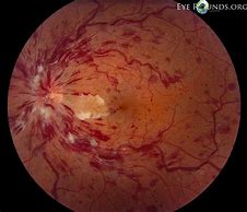 Image result for Yellow Spot On Retina