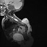 Image result for Meningomyelocele Radiology