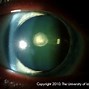 Image result for Cataract