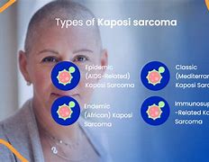 Image result for Types of Kaposi Sarcoma