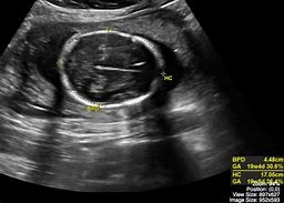 Image result for Normal Pregnancy Ultrasound