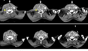 Image result for Hematoma After Carotid Endarterectomy