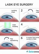 Image result for Lasik Eye Surgery Flap