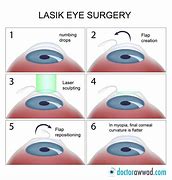 Image result for Lasik Eye Surgery Machine