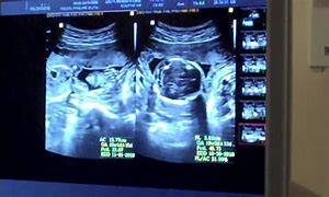 Image result for Anencephaly On 12 Week Ultrasound