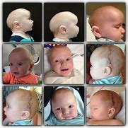 Image result for Craniosynostosis Baby Head Shapes