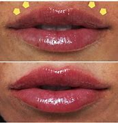 Image result for Botox Lips Pictures