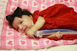 Image result for Babies Born with Anencephaly