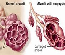 Image result for adenoloh�a