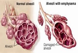 Image result for adenopwt�a