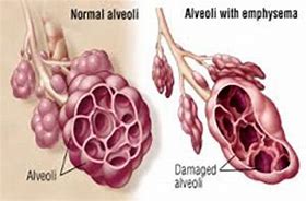 Image result for adenolat�a