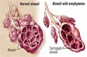Image result for adenolof�a