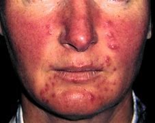Image result for Pustular Rash On Face