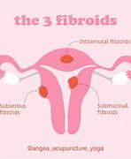 Image result for 6 Cm Uterine Fibroid