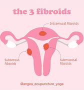 Image result for Uterine Fibroid Tumors