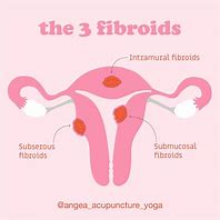 Image result for Small Uterine Fibroid
