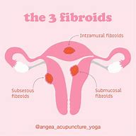 Image result for 7 Cm Fibroid Picture