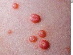 Image result for Molluscum Dimple