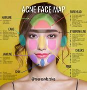 Image result for Acne Location Map