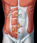 Image result for What Does a 5 Cm Hernia Look Like