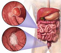 Image result for Tumour in Colon