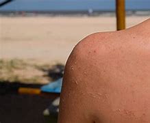 Image result for Skin Cancer From SunBurn
