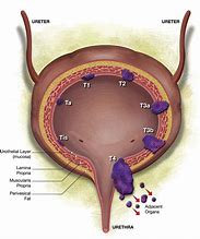 Image result for Sessile Bladder Tumor