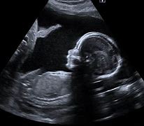Image result for Fetal Anomalies Ultrasound