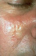 Image result for Basal Cell Carcinoma Skin Cancer Nose