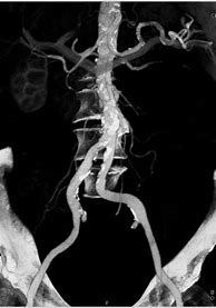Image result for Large Renal Cyst