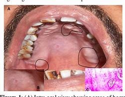Image result for Maxillary Palatal Exostosis