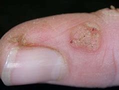 Image result for Water Warts