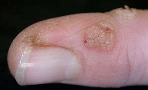 Image result for Wart On Arm