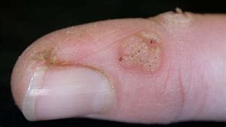 Image result for Cutaneous Warts