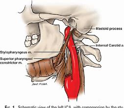 Image result for Cervical Internal Carotid Artery