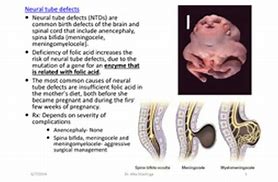 Image result for Meningomyelocele