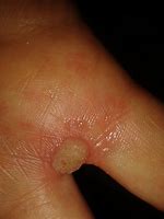 Image result for Large Wart Treatment