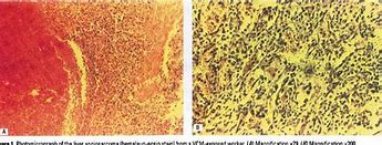 Image result for Angiosarcoma Pics